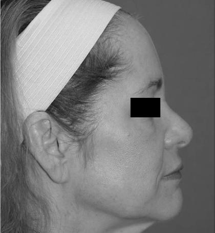 With aging, the tip of the nose becomes longer due to loss of the tip support. Supporting the tip with a rhinoplasty, at the same time as a face lift, can provide a much more youthful appearance.