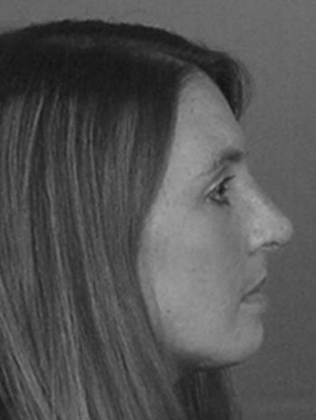 This young woman also had a chin augmentation (implant)