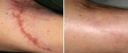 color match with the surrounding skin, is oriented along the relaxed skin tension lines (RSTLs), and does not produce any distortion of adjacent tissues.