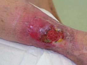 ISSUE 2, July 2012 Adhesive Trauma Adhesive trauma is a serious and yet largely preventable problem.