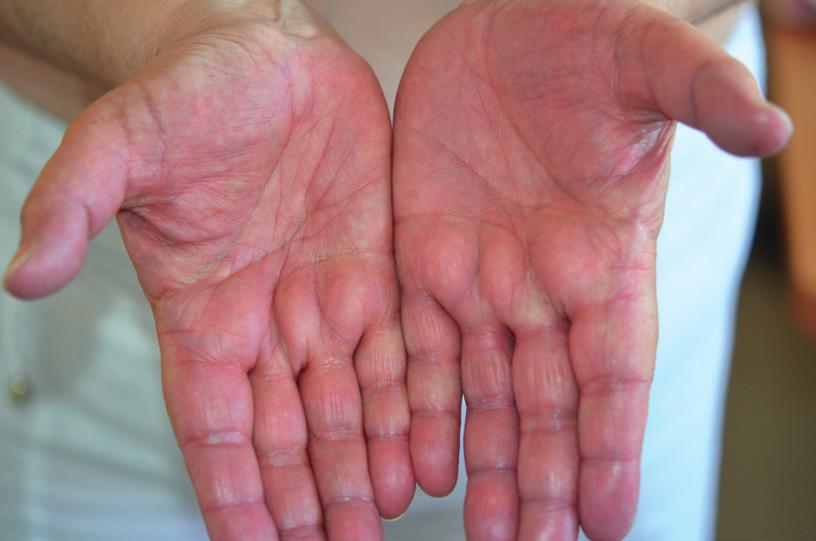 Hand-foot syndrome IMPORTANT M Hand foot syndrome may be caused by certain chemotherapies and certain targeted therapies.