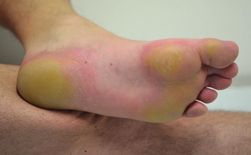 chemotherapies. M Nevertheless, there are a number of points in common: hand foot syndrome is always bilateral and occurs on the palms and/or soles.
