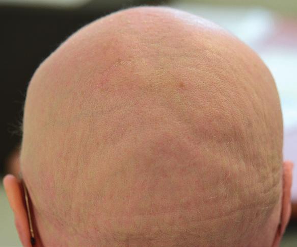 Alopecia and its effect on hair IMPORTANT M Alopecia caused by chemotherapy is often considered to be the patient s worst burden.