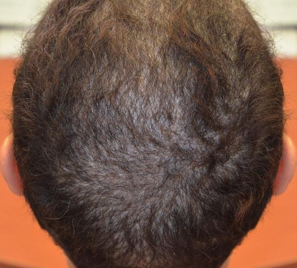 M The hair may look different when it grows again (whiter, more curly). M Patients need support to cope with this side effect.