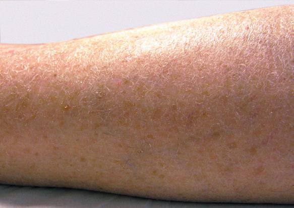 Cutaneous xerosis IMPORTANT TREATMENT M Cutaneous xerosis is a clinical situation encountered frequently amongst patients undergoing chemotherapy, targeted therapies or hormone therapy.