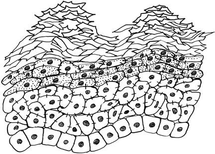 Desquamating cell Stratum corneum Keratohyaline granule Granular layer Spinous layer Desmosome Basal layer A Desmosome Dermis Dry Skin Stratum corneum Granular layer CHAPTER 11 DRY SKIN Spinous layer