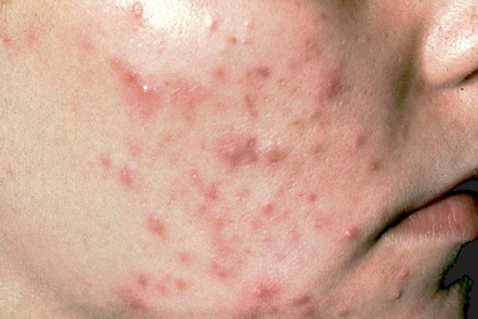 ing unless the subject also suffers from Baumann S2 sensitive skin with a tendency to flush (see Chapter 17). FIGURE 12-1 Inflammatory pustules seen in acne.