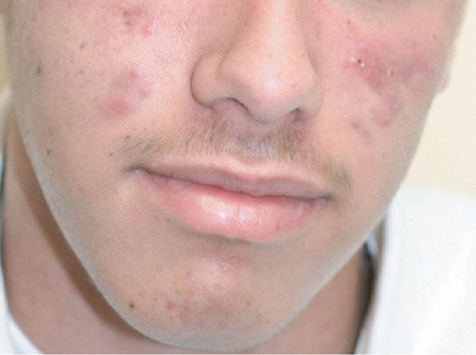 FIGURE 15-6 Cystic acne on cheeks. the sebaceous follicle.