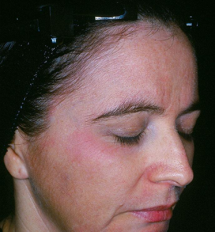 epidermolysis. Allergic contact dermatitis has been reported to occur with resorcinol, salicylic acid, kojic acid, lactic acid, and hydroquinone.