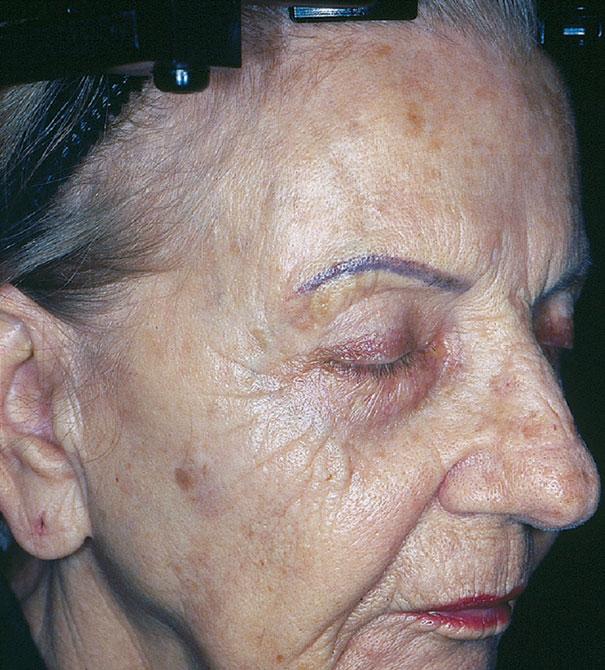 FIGURE 20-16 Patient with photodamage prior to one coat of a Jessner s peel followed immediately by the Accupeel 16%.