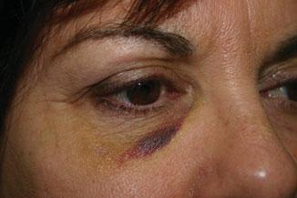 CHAPTER 21 Prevention and Treatment of Bruising Susan Schaffer, RN Sogol Saghari, MD Leslie Baumann, MD Ecchymoses, also known as bruises, occur as a result of an injury to the capillaries, allowing