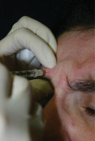 COSMETIC DERMATOLOGY: PRINCIPLES AND PRACTICE FIGURE 22-4 Procerus injection site. A B FIGURE 22-5 Angle of injection of the corrugator muscle. A. Use one hand to isolate the corrugator muscle. B. Rest the finger of the other hand on the nose as shown in A to stabilize the hand.