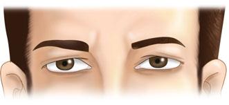 Alternately, injections can be performed in the higher regions of the forehead in patients with low brows.