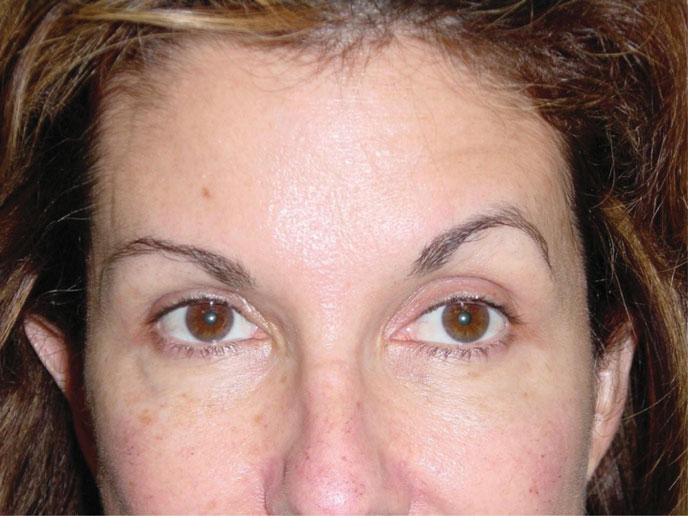 This can be avoided or corrected by injecting 4 units of Botox 2 cm above the lateral brow in the area of muscle movement.