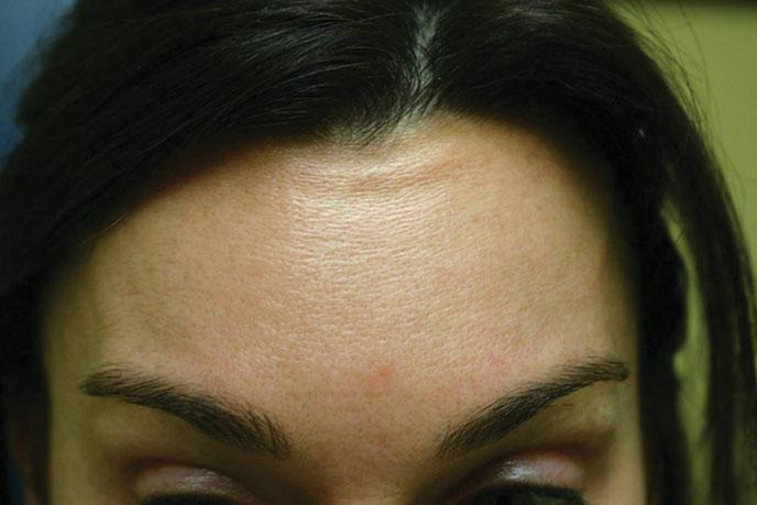 FIGURE 22-14 The physician who injected this female missed the area just below the hairline.