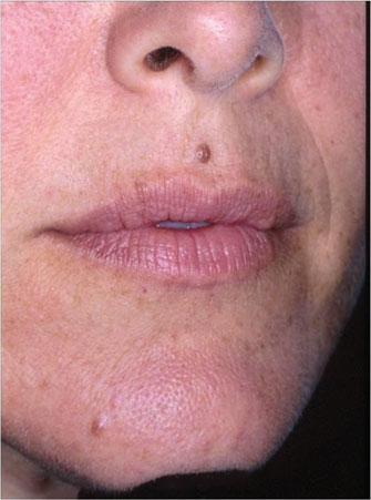 COSMETIC DERMATOLOGY: PRINCIPLES AND PRACTICE FIGURE 23-3 Collagen hypersensitivity reaction after 11 days of treatment with cyclosporine 5 mg/kg/d. The lesions flattened and had decreased redness.