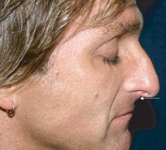 A B C FIGURE 23-5 A. This patient has a dropped nasal tip. Options to raise the tip include a dermal filler or a botulinum toxin. B. CosmoPlast or Restylane is placed just below the cartilage of the central nose as shown with the white arrow.