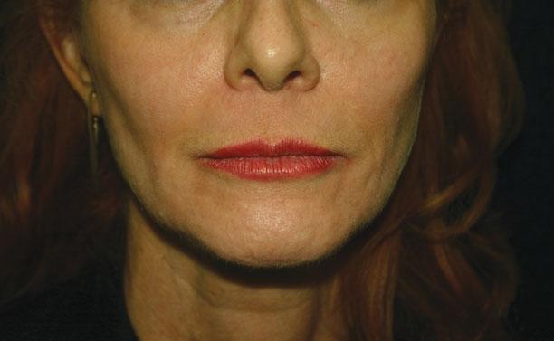 For example, if the patient has prominent nasolabial folds, there are two main options: treating the nasolabial folds, or treating the cheek or cheekbone area to add volume that will improve the fold