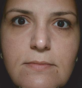 A FIGURE 24-7 A. Rosacea before IPL treatment. B. Rosacea after one IPL treatment. 2 3 more will be needed for maximum results.