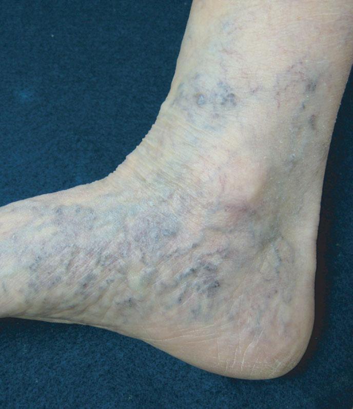 damage, flavonoids (plant-derived free radical scavengers) have been shown to ameliorate the symptoms and progression of chronic venous insufficiency.
