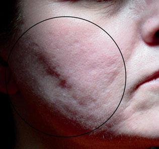 Treatment of scarring remains an evolving subject among dermatologic surgeons.