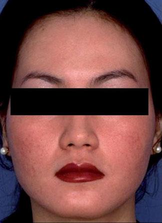 COSMETIC DERMATOLOGY: PRINCIPLES AND PRACTICE Medium-depth chemical peel Stretchable Laser resurfacing shallow atrophic scars.