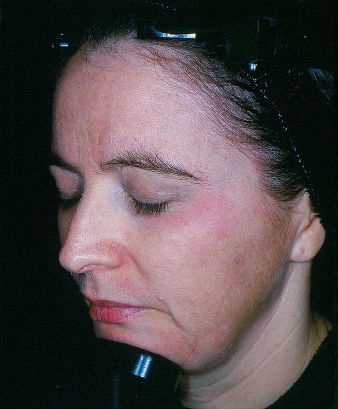 FIGURE 30-4 Redness, flaking, and tender skin are common symptoms after beginning a retinoid. These symptoms usually improve with time.