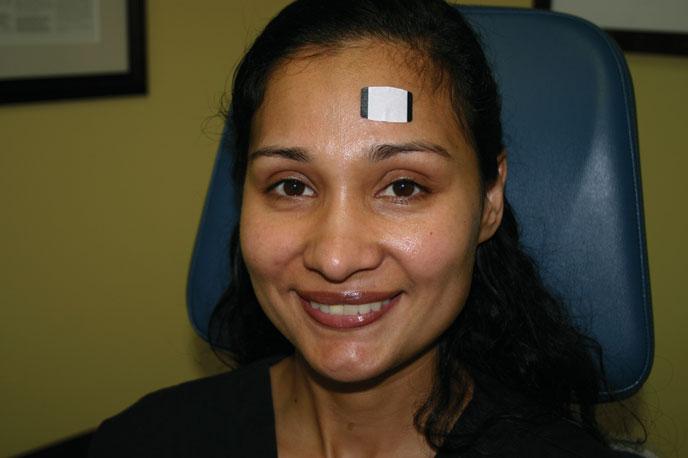 FIGURE 38-2 Sebutape placed on the forehead to measure sebum secretion. buffering capacity the smaller the changes in cutaneous ph.