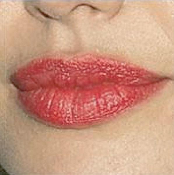 FIGURE 40-4 What is considered to be the ideal mouth is characterized by fullness, a well-defined philtrum, and a lower lip twice as long as the upper lip.