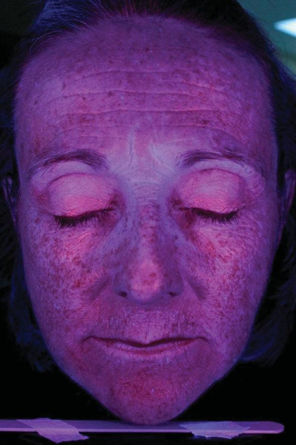 also result in less nutrient transfer between the dermis and epidermis. COSMETIC DERMATOLOGY: PRINCIPLES AND PRACTICE FIGURE 6-4 Photoaging as seen under blue light.