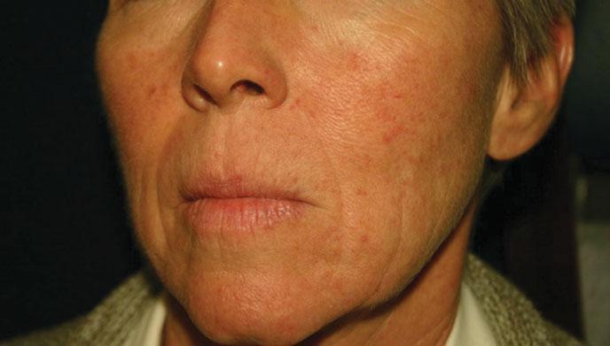 FIGURE 6-6 Photoaged skin shows telangectasias, solar lentigos, and wrinkles. the fact that neither an animal model nor an in vitro model of wrinkling has been established.