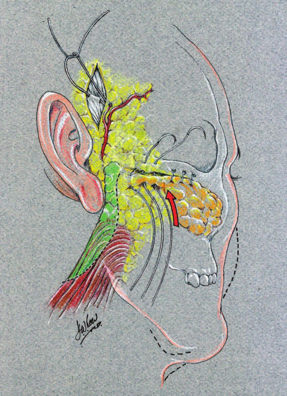 Volume 117, Number 3 Suture Suspension Malarplasty the earlobe and then into the neck along the anterior border of the sternocleidomastoid muscle (Fig. 3).