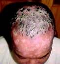 He was suffering from scalp psoriasis, a ahead of him. Noing was going right and condition in which e skin cycle gets altered is problem added to his woes.