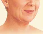 Neck Lift If you are concerned about the loss of youthful contours in your face and neck, or you notice excess wrinkling of the neck skin, a turkey wattle or double chin, and jowl lines and you are
