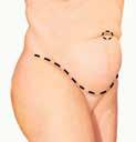 Incision size is largely dependent on the amount of excess skin to be removed.