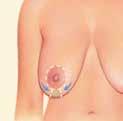 Breast Lift A breast lift raises and firms the breasts by removing excess skin and tightening the surrounding tissue