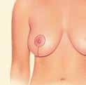 Sometimes the areola becomes enlarged over time, and a breast lift will reduce this as well.