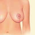 After your doctor makes the incisions, the underlying breast tissue is lifted and shaped to improve breast contour and