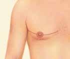 unilaterally (one breast) or bilaterally (both breasts) Gynecomastia can be surgically treated by removing excess fat, glandular tissue and/or skin.