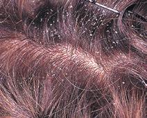 Common dry, scaly scalp conditions Dandruff Dandruff (sometimes referred to as pityriasis capitis) occurs in many people at some stage during their lifetime.