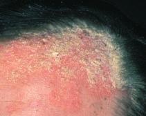 These different forms of dry, scaly scalp conditions can be recognised from signs such as flakes of skin in the hair, a pink and itchy scalp or dense scale on the head.