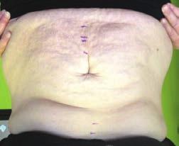 Ultrasonic cavitation is considered as a treatment alternative to surgical liposuction as a non-invasive procedure for the body. 1 treatment 50.00 4 treatments 180.