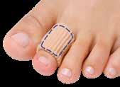 pressure and friction, separate toes that rub. Relieve corns, crooked and overlapping toe irritations.