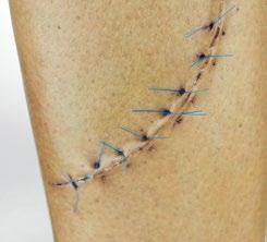 Wound Closures Sutures (Stitches) Sutures (stitches) are fine threads sewn through the skin to bring a wound together.
