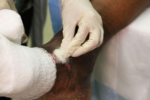 SKILL Put on a New Dressing 1. After cleaning the wound, place a new primary dressing or clean gauze on the wound. 2.