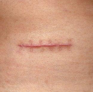 Incisional wounds are made by cutting through skin, muscle, and fat so that a body part can be repaired or