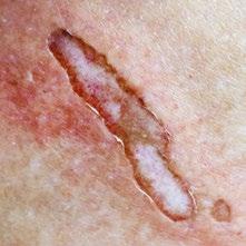 Excisional wounds are made for the removal of a cyst or other type of tissue.
