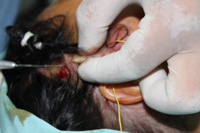 and galea aponeurotica. The needle is loaded and the suture is placed into the supragaleal plane. D.