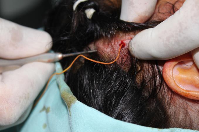 NB1 Take care not to insert hair subdermally with the suture loop. F.