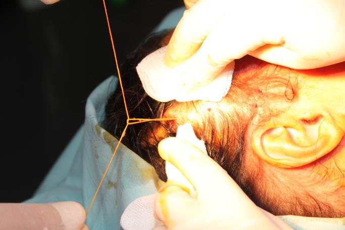 Both suture ends are at point A. J.